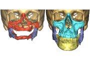 Planification 3D de la transplantation faciale.... (Photo fournie par Daniel Borsuk) - image 7.0