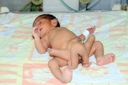 Le bébé était atteint de conjonction parasitaire, une... (Photo: AFP)