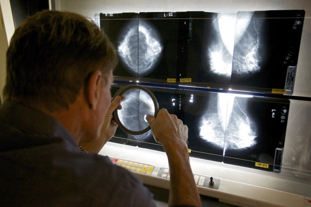 Depuis le recours systématique à la mammographie aux... (PHOTO  DAMIAN DOVARGANES, AP/PC)