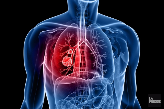 cancer du poumon la fin