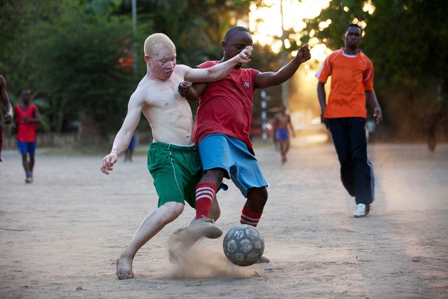 Le président tanzanien promet de protéger les albinos «Mettre fin aux meurtres d'albinos, cela est possible,... (PHOTO YASUYOSHI CHIBA, AGENCE FRANCE PRESSE)