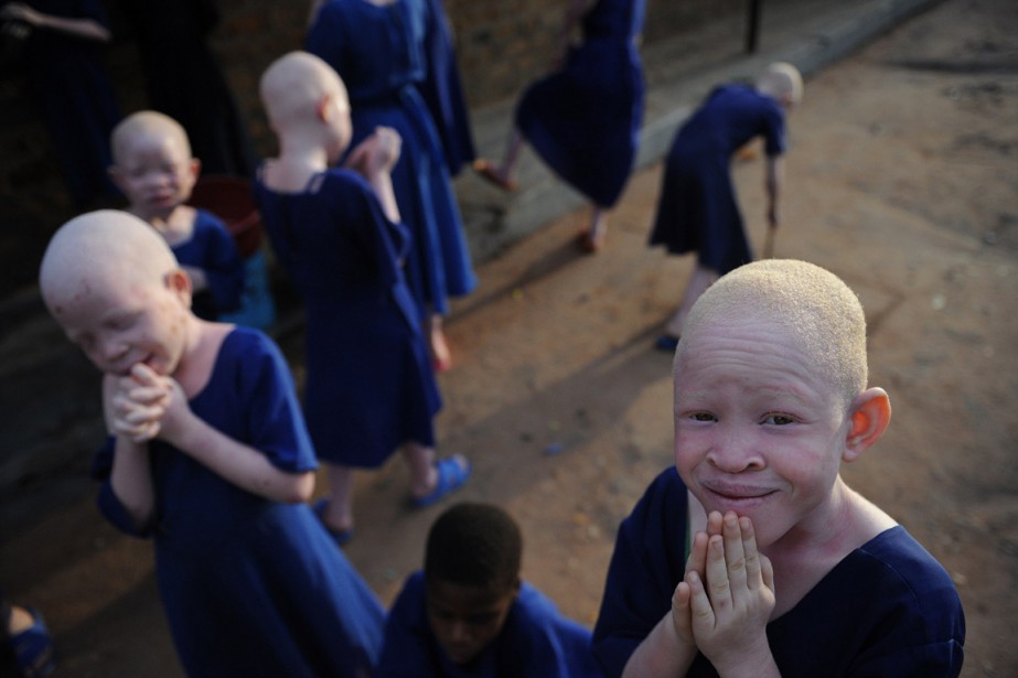 Tanzanie des albinos persécutés et mutilés Afrique