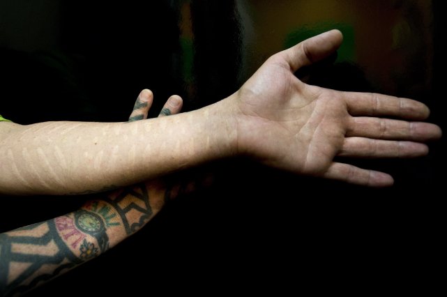 les cicatrices plutôt que le tatouage | erica lenti | santé