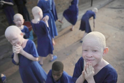 En Tanzanie Des Albinos Pourchasses Vivent Terres Et Terrorises La Presse