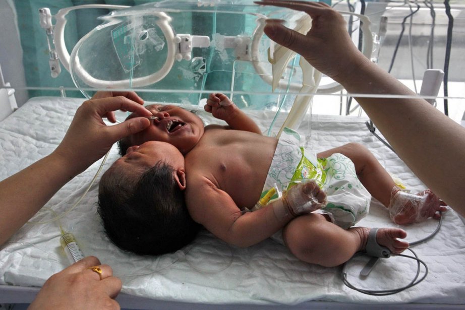 Naissance D Un Enfant A Deux Tetes En Chine La Presse